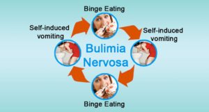 Bulimia Nervosa Image