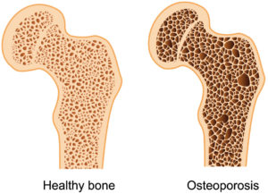 Foods to avoid with osteoporosis 