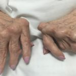 Rheumatoid Arthritis and Managing Psoriatic Arthritis