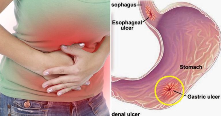 Foods that trigger Gastritis