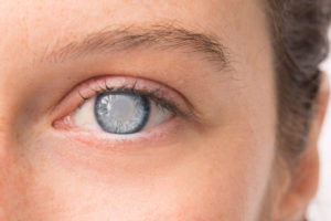 Foods that cause Cataracts