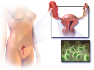 Female Genital Infection 