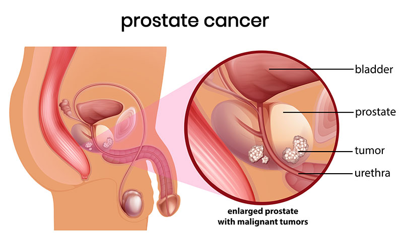 Natural Remedies for Prostate Cancer