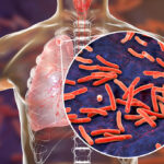 Natural Treatment for Tuberculosis