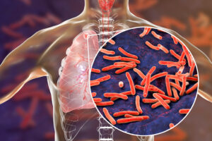 Natural Treatment for Tuberculosis