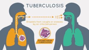 Natural Treatment for Tuberculosis 