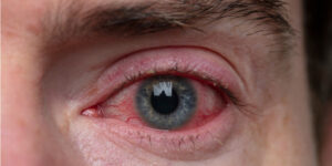 Home Remedy for Eye Redness