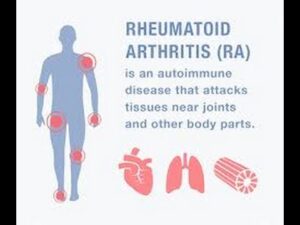 Rheumatoid Arthritis Treatment at Home 