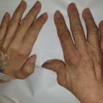 Rheumatoid Arthritis Treatment at Home