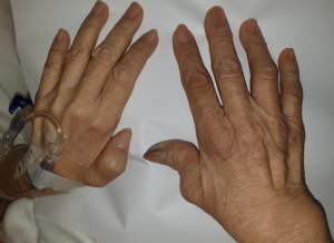 Rheumatoid Arthritis Treatment at Home