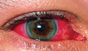Home Remedy for Eye Redness 