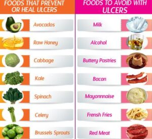 Ulcer Foods To Eat