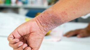 Dermatitis or Eczema 
