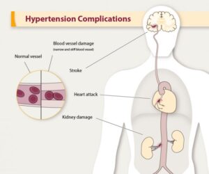 Hypertension 