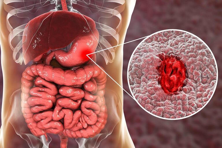 Home Remedies for Stomach Ulcer