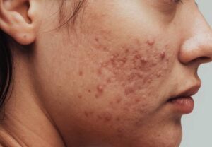 Acne treatment at home and Foods to avoid with acne