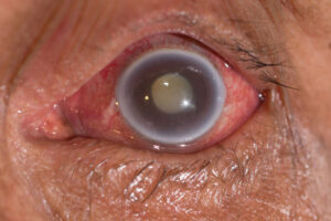 Glaucoma Natural Remedies