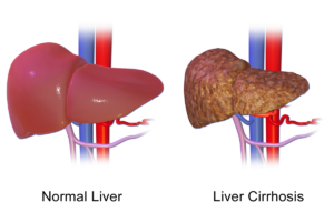 Liver Cirrhosis Diet 