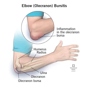 Elbow Bursitis Treatment at Home