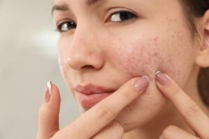 Acne Treatment At Home