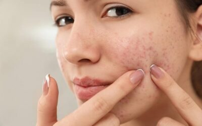 Acne treatment at home