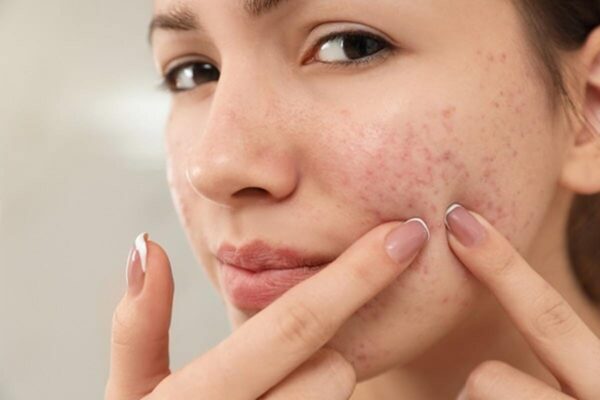 Acne treatment at home