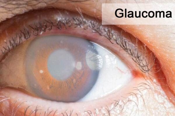Glaucoma Natural Remedies