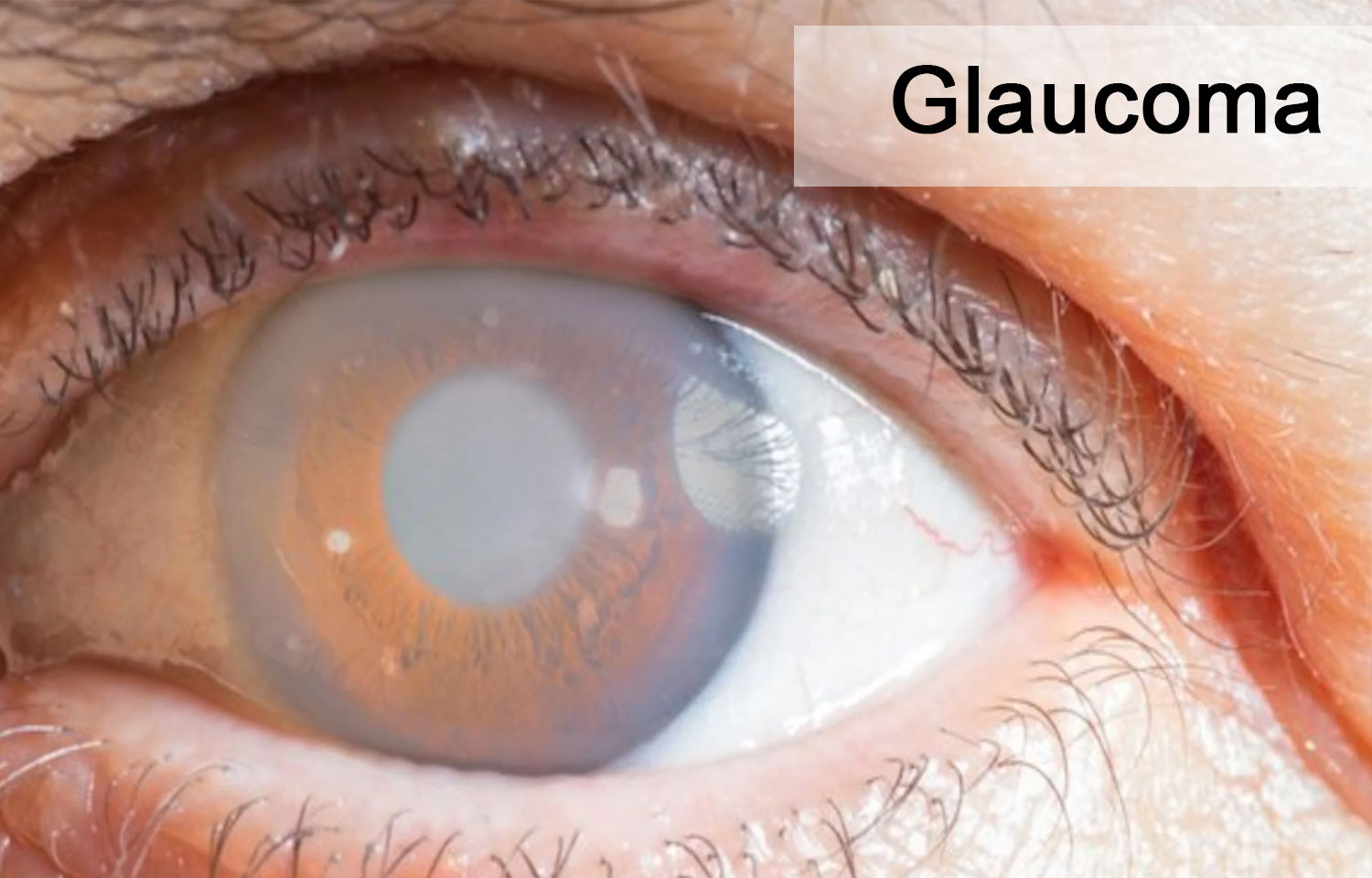 Glaucoma Natural Remedies