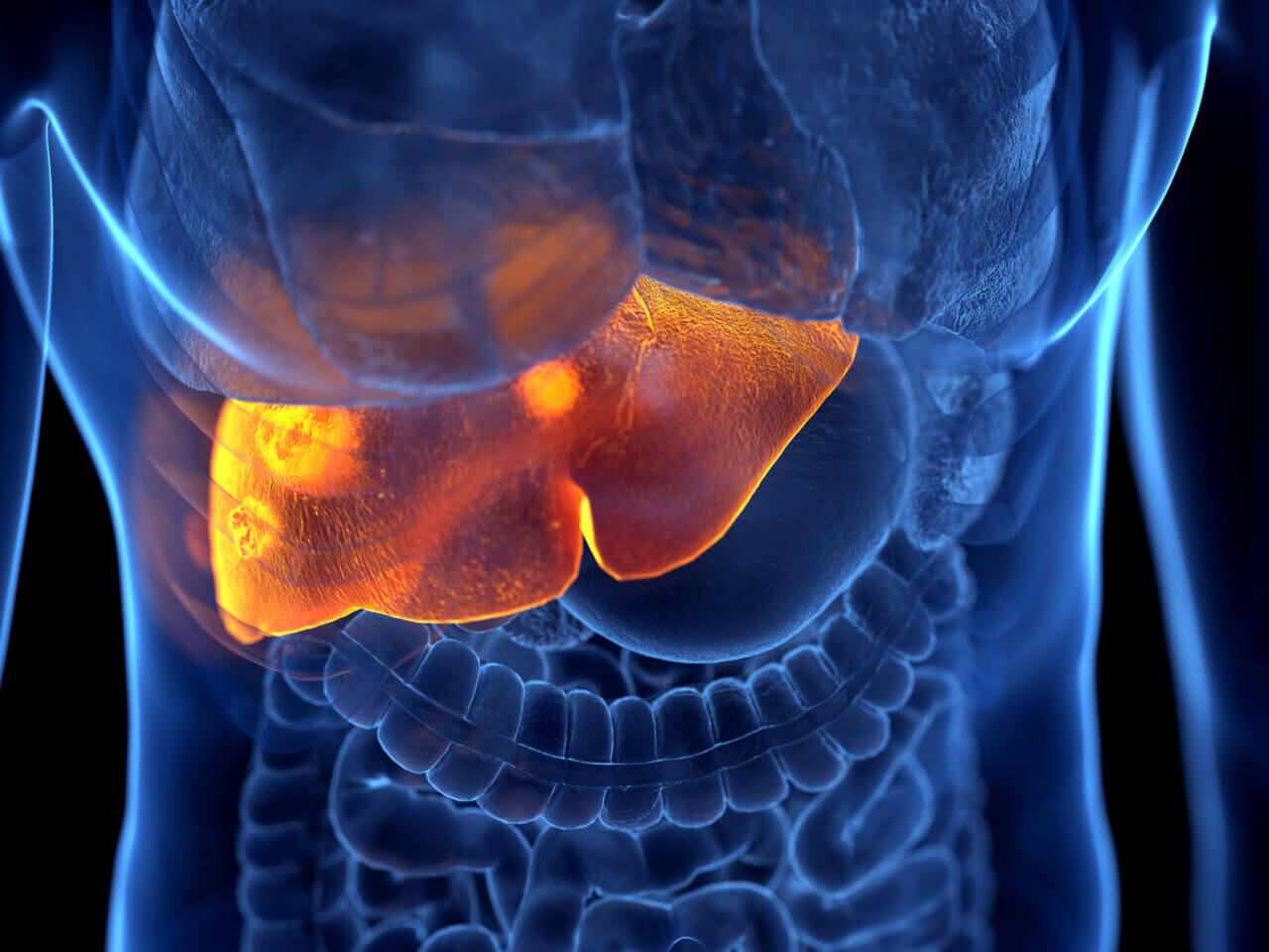 Liver Cirrhosis Diet