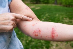 Home Remedies for Poison Ivy