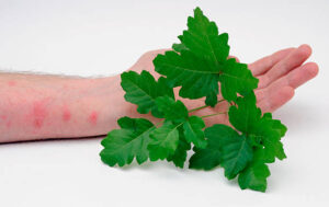 Home Remedies for Poison Ivy