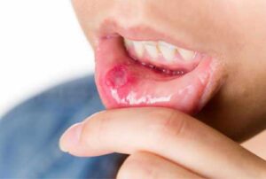 Home Remedies for Mouth Ulcers