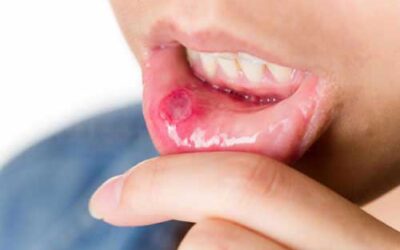 Home Remedies for Mouth Ulcers