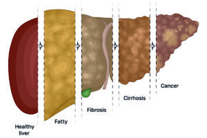 Fatty Liver Disease