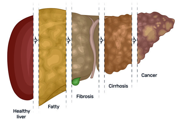 Fatty Liver Disease