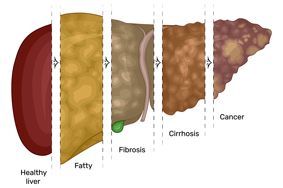 Fatty Liver Disease My Emerald Health