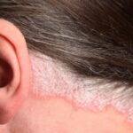 Home Remedies for Scalp Psoriasis