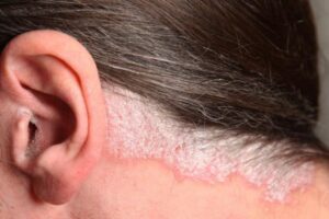 Home Remedies for Scalp Psoriasis