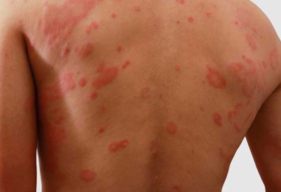 Urticaria Home Remedies