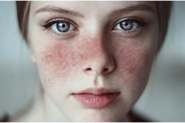 Natural Treatment for Lupus