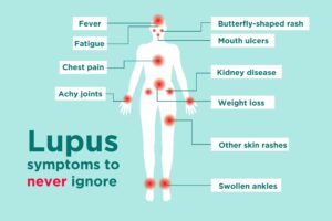 Natural Treatment for Lupus 