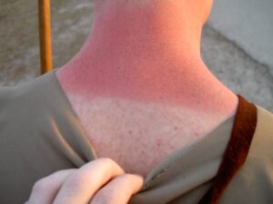 Natural Remedies for Sunburn