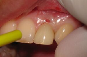 Cold sores on gums