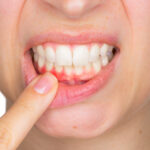 Cold sores on gums