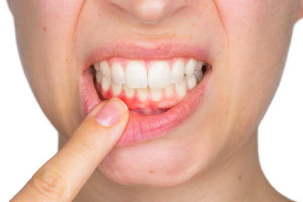 Cold sores on gums