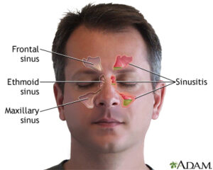 Sinus Trouble Remedies 