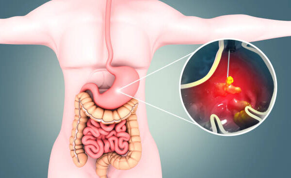 Foods That Help Heal A Stomach Ulcer