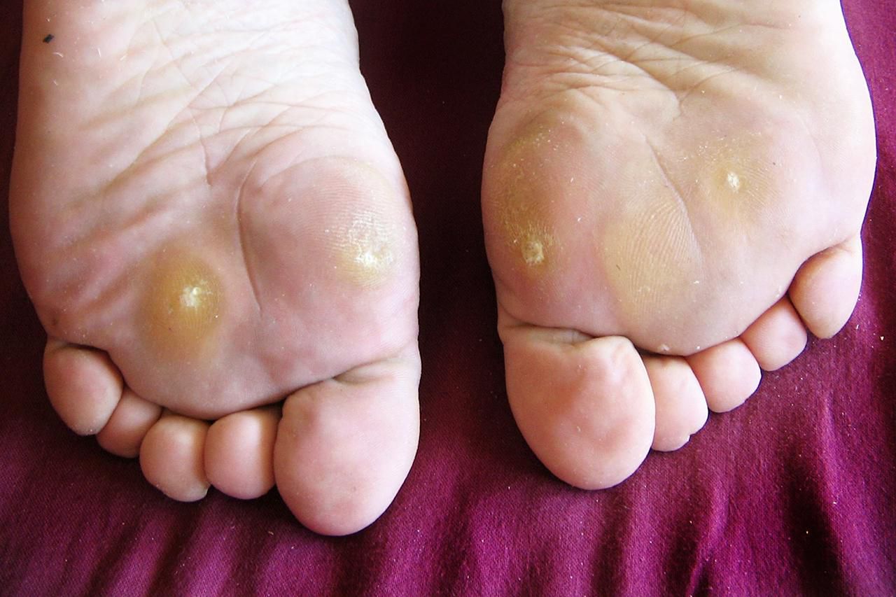 Warts on Feet