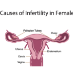 Causes of Female Infertility