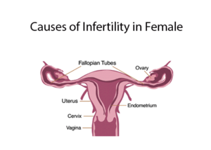 Causes of Female Infertility